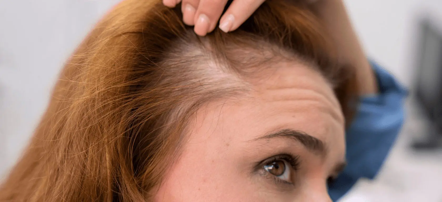 Calvicie prematura: la alopecia que sufren los hombres jóvenes
