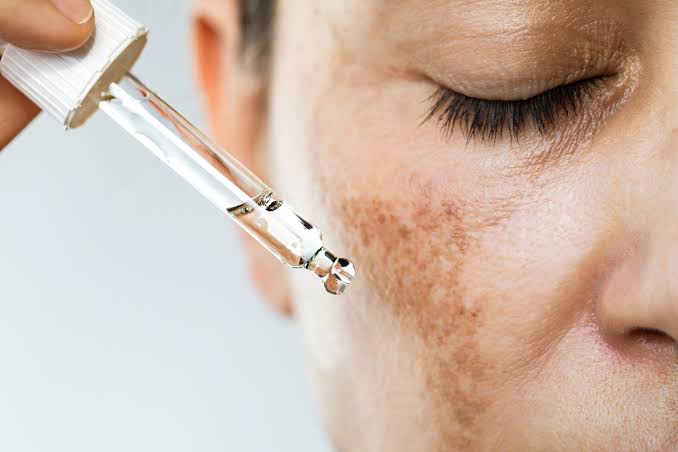 Cómo eliminar manchas en la cara: tratamientos que funcionan